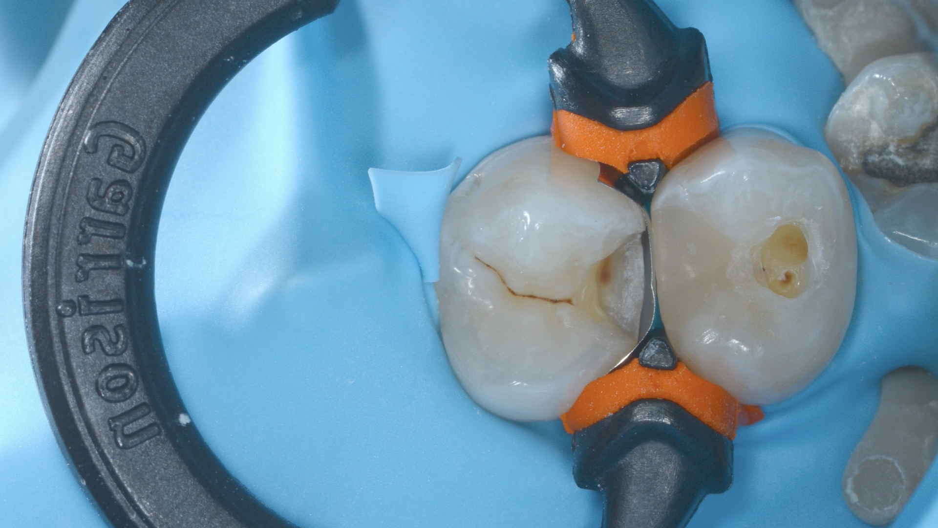 Placing a Sectional Matrix Band correctly