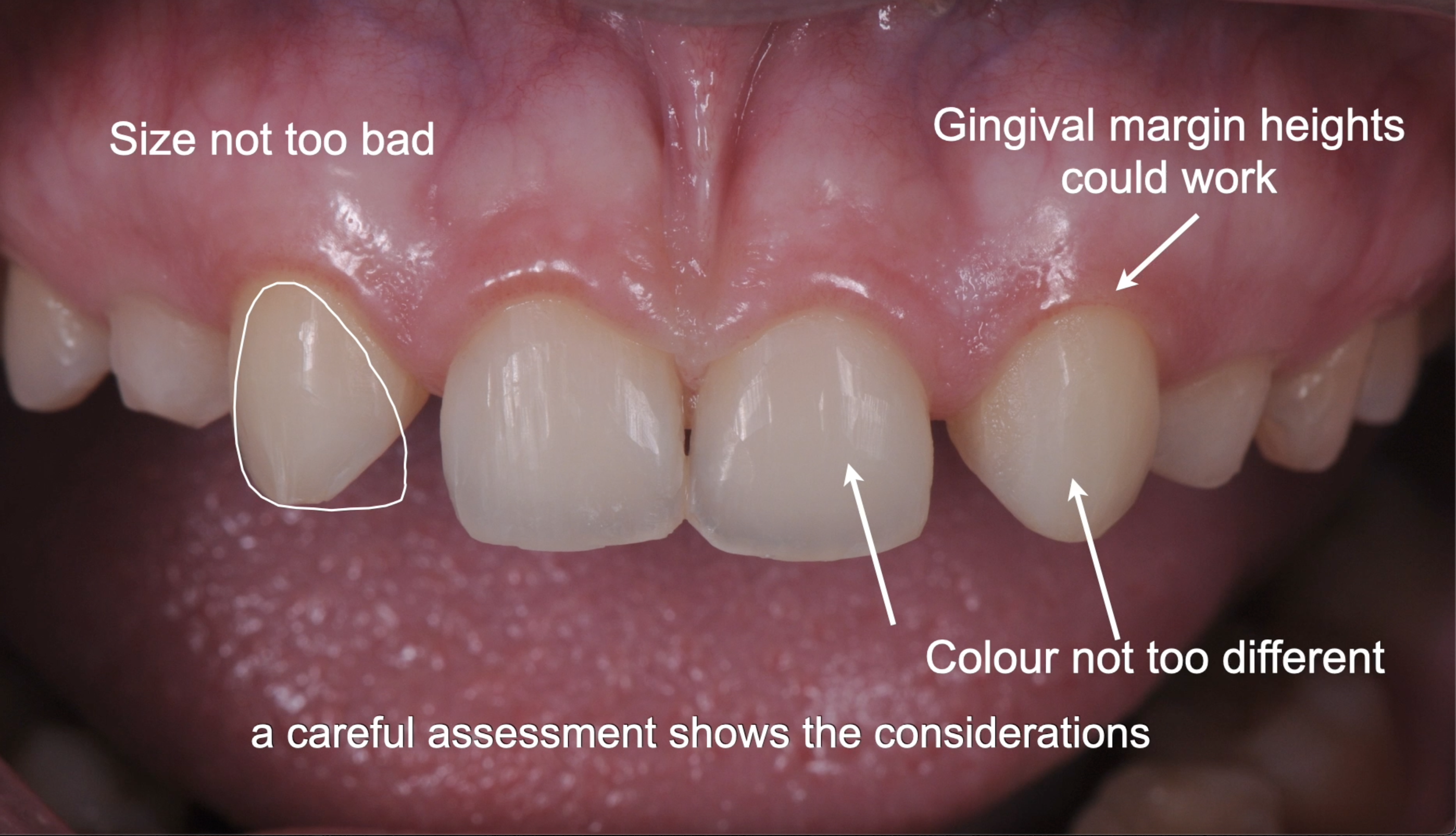 Replacing Missing Maxillary Lateral Incisors