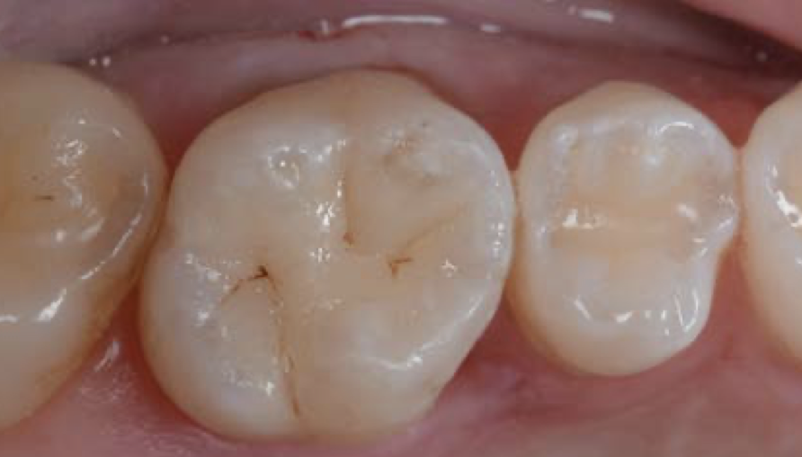 Posterior Composites - the  full workshop