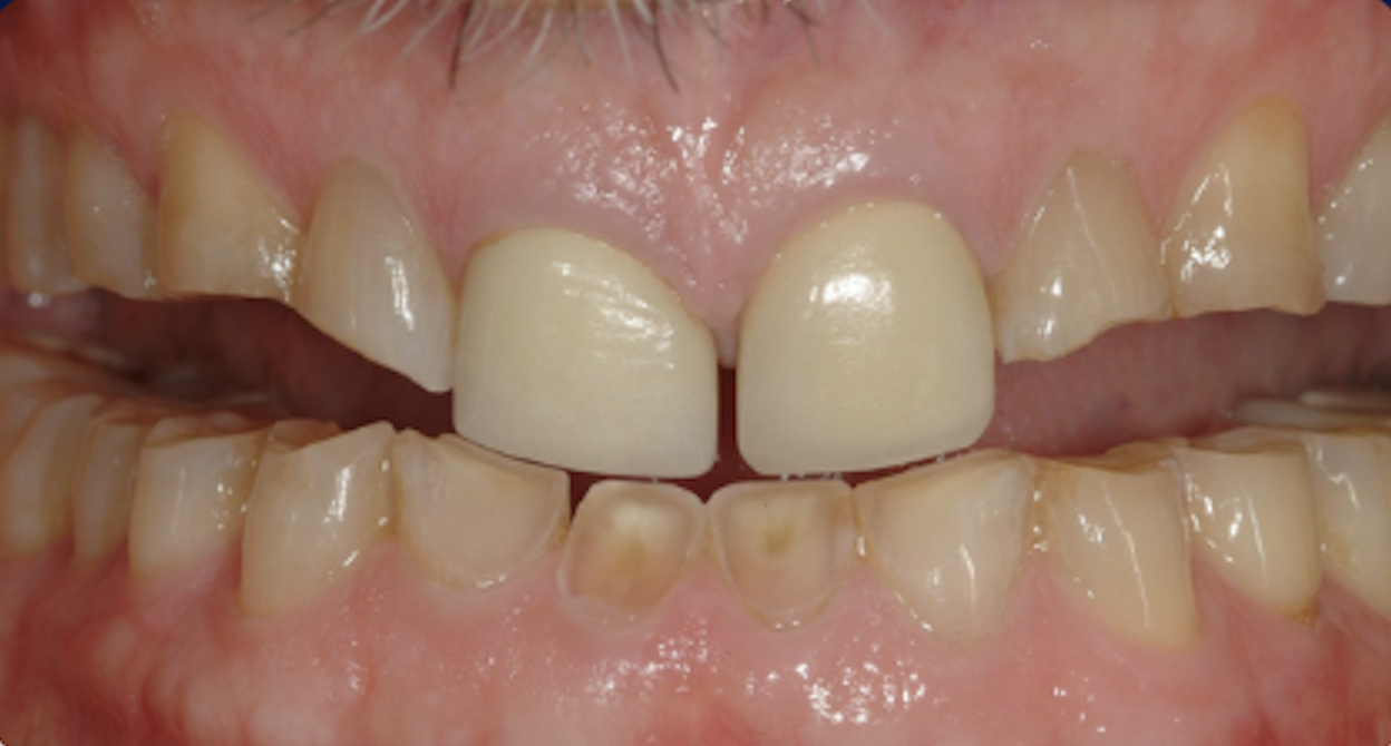Diagnosis and Management of the Worn Dentition