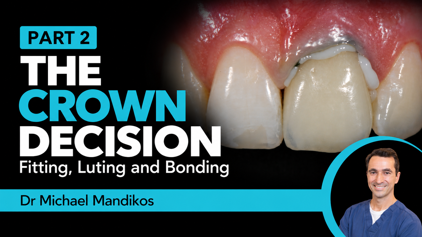 The Crown Decision - Part 2 - Fitting, Luting and Bonding