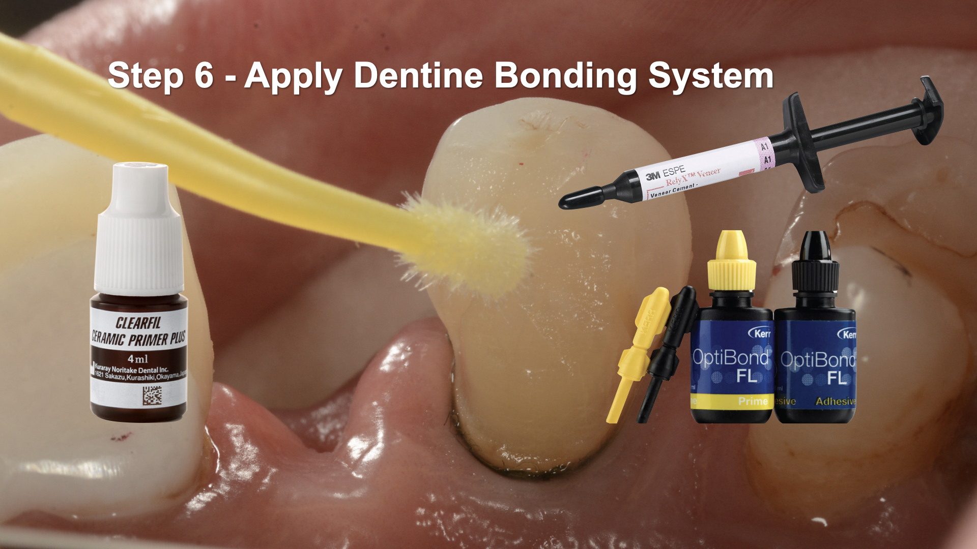 How to bond a Zirconia "Maryland" Bridge