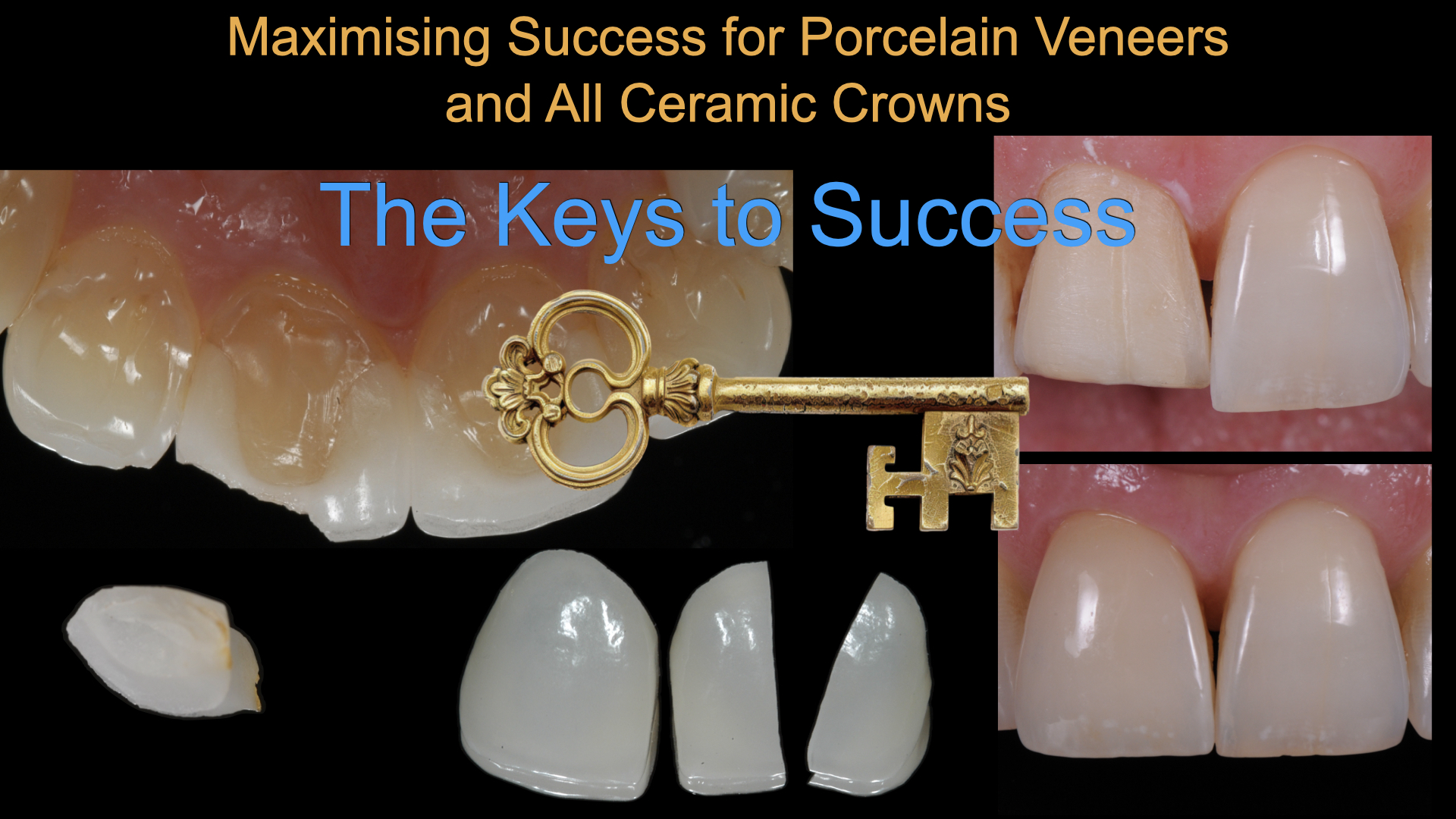Maximising Success with All-Ceramic Crowns and Veneers
