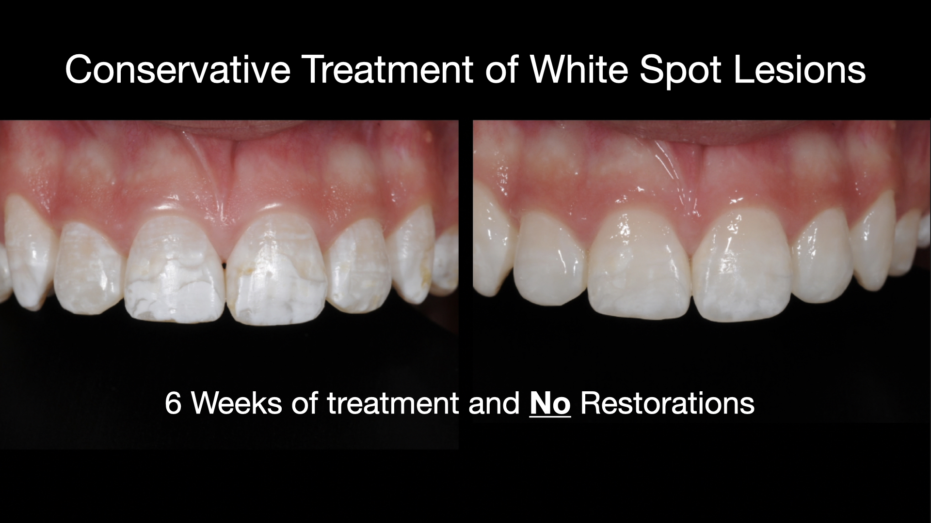 Treating White Spot Lesions Preview
