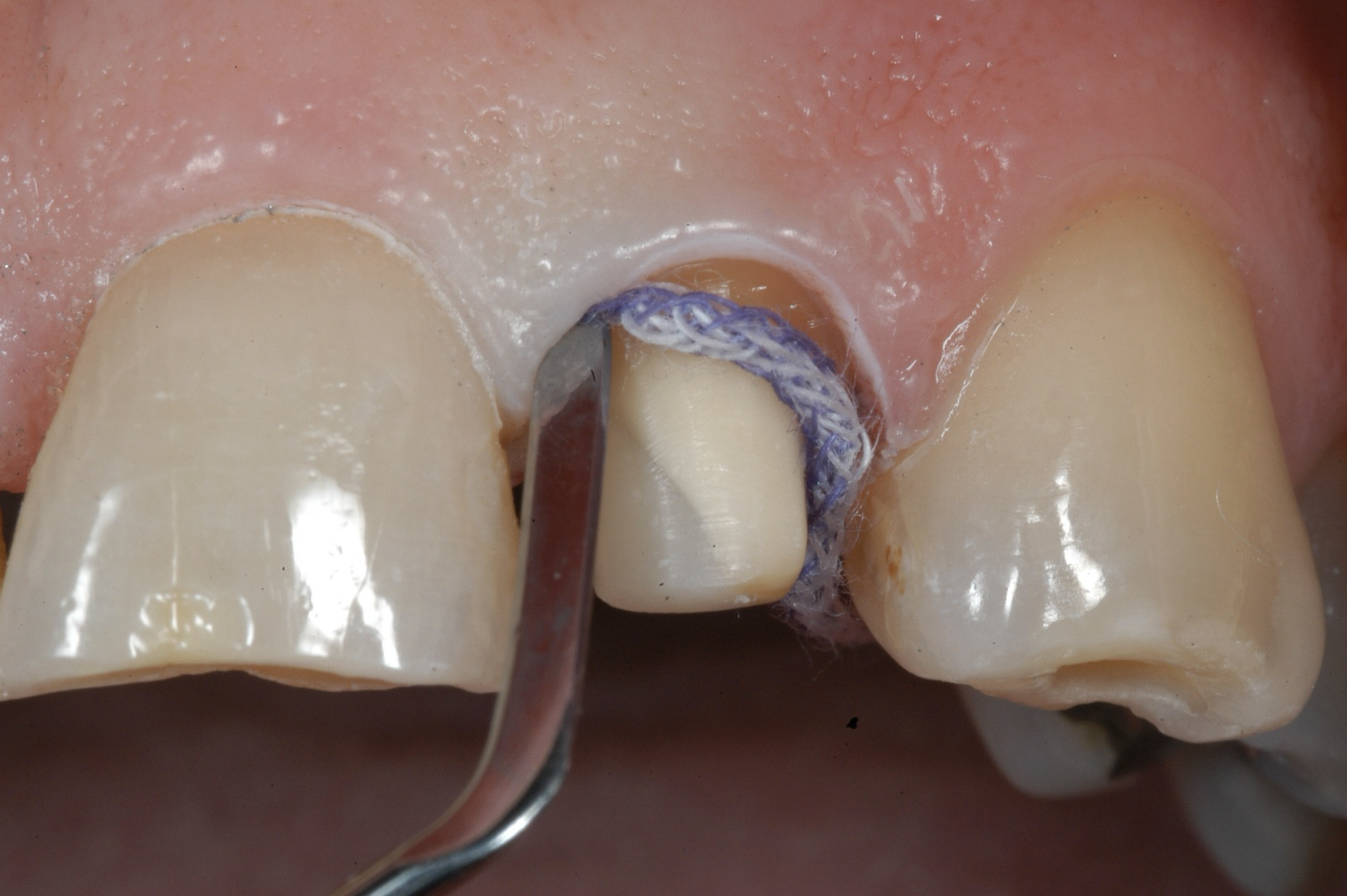 Easily Pack a Retraction Cord