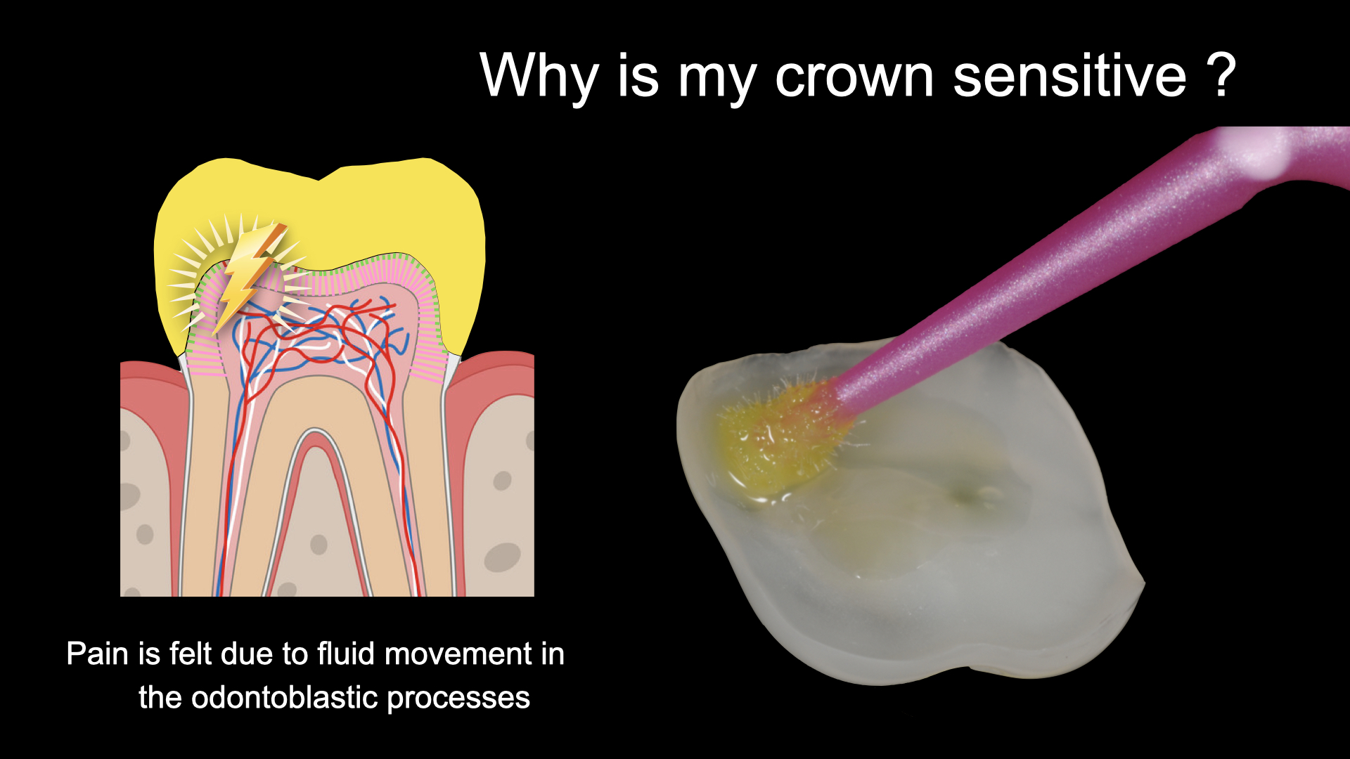 Why is my new crown sensitive ?
