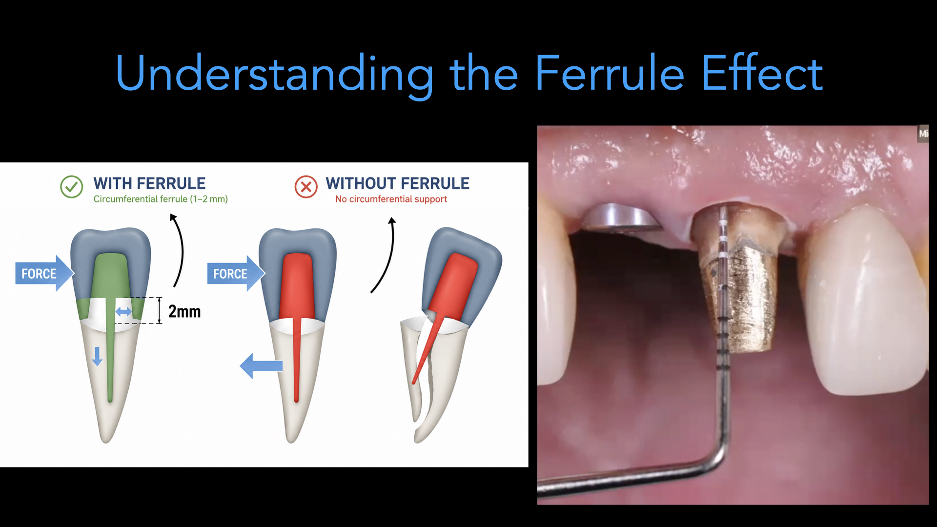 Understanding the Ferrule Effect Preview